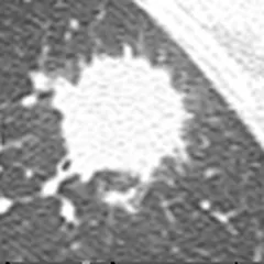 Nódulo pulmonar de borde espiculado en TAC