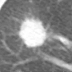 Nódulo pulmonar de borde irregular en TAC