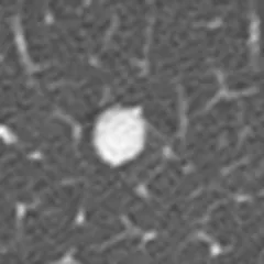 Nódulo pulmonar de borde liso en TAC