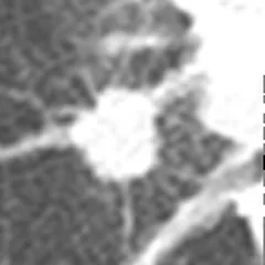Nódulo pulmonar de borde lobulado en TAC