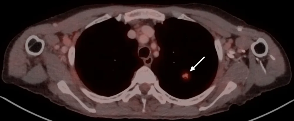 Corte axial de PET-CT de tórax con un nódulo pulmonar