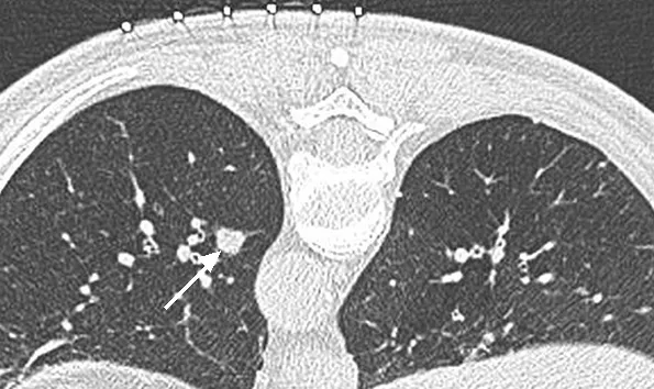 TAC de tórax con un nódulo pulmonar sólido